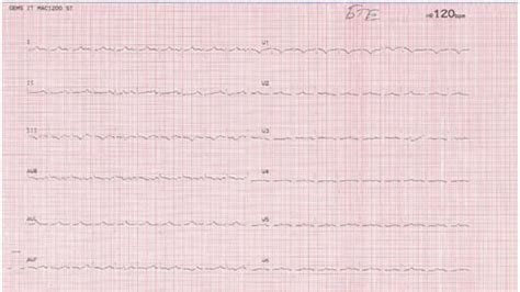 The ECG on admission shows sinus tachycardia with a rate of 120, a deep ...