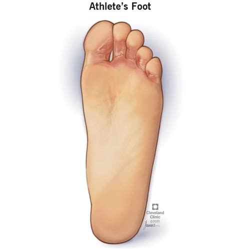 Athlete's Foot or Toenail Fungal Infection: Symptoms & treatment - The ...