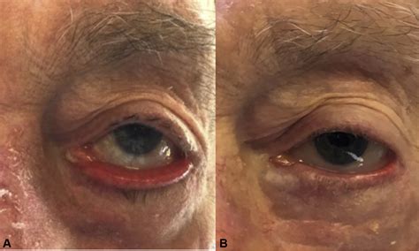 Correction Of Cicatricial And Involutional Lower Eyelid Ectropion With