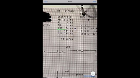 Ecg Junctional Rhythm Youtube