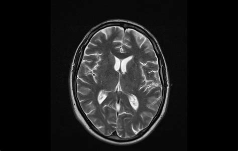 A Clinical Reasoning Exercise: Dysmetria, Nausea, Vomiting, Trouble to ...