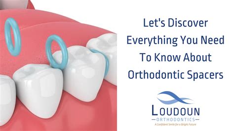 Everything You Need To Know About Orthodontic Spacers