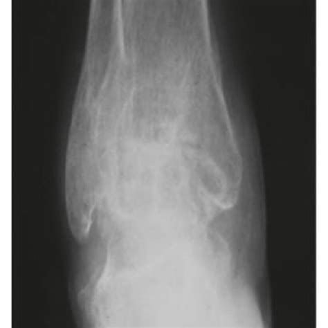 The X-ray image of an ankle joint. | Download Scientific Diagram