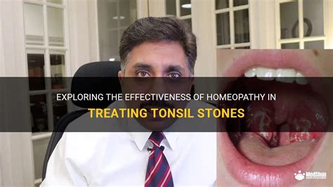 Exploring The Effectiveness Of Homeopathy In Treating Tonsil Stones Medshun