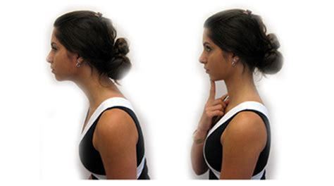 Forward Head Posture Maya Physio