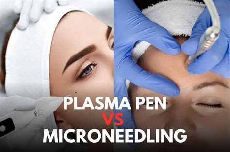 Plasma Pen Vs Microneedling Fitness Beauty Art