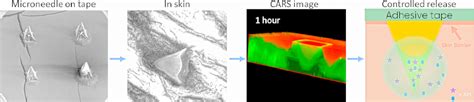 Dissolvable Microneedles For Transdermal Drug Delivery Showing Skin