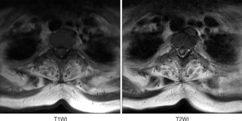 Axial View Of The Spinal Mri Demonstrating Thecal Sac I Open I