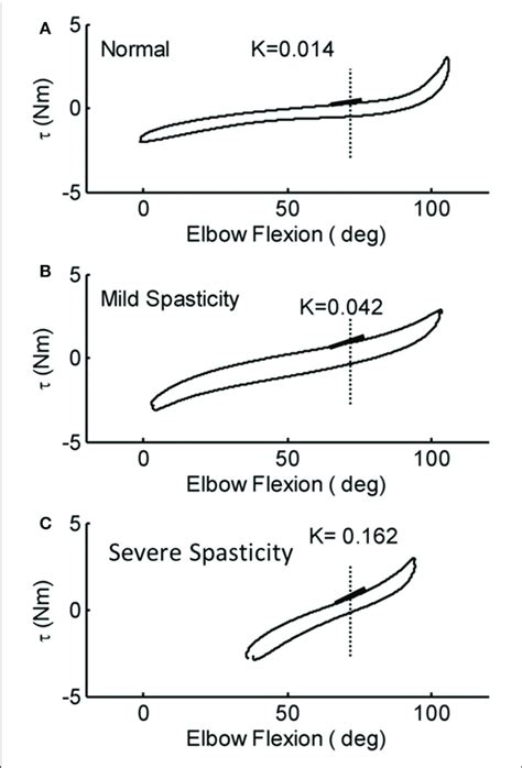 Representative Torque Angle Curves Of Stroke Survivors Mild B And