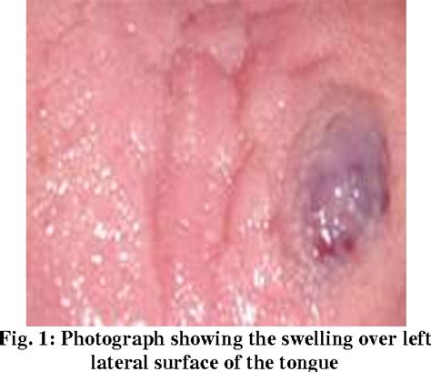 Figure 1 From Cavernous Hemangioma Of The Tongue A Rare Case Report