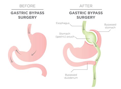 Bypass Gástrico — Somabariatrics