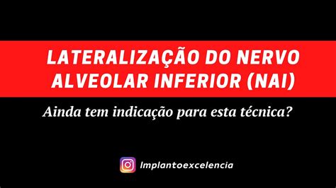 Lateralização do Nervo Alveolar inferior Ainda existe indicação para