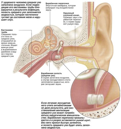 Шунтирование барабанной полости (Лечение - Хирургия) - Medsest.ru