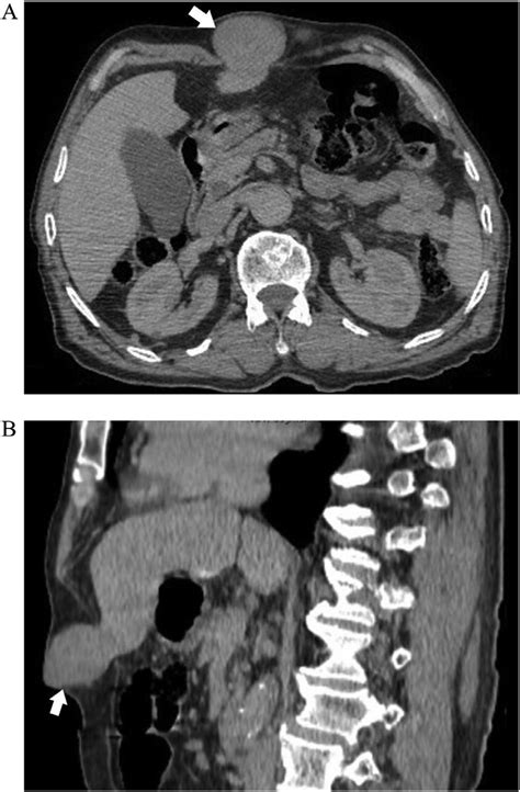 Abdominal Contrast Enhanced Ct Scan At The Portal Phase In The Axial