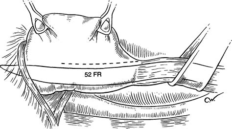 The Collis Nissen Procedure Operative Techniques In Cardiac And