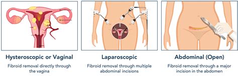 Stomach Pictures After Myomectomy Surgery