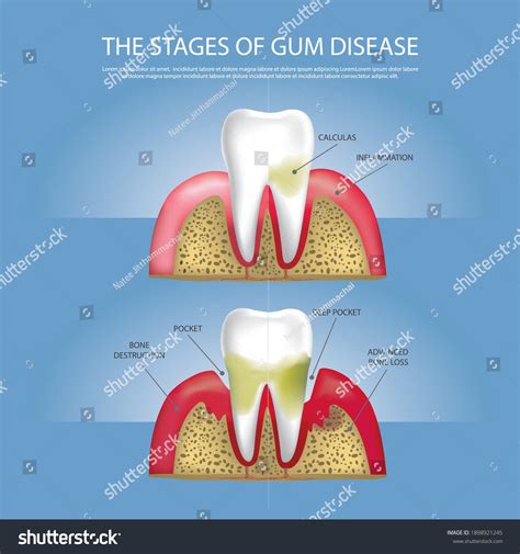 Human Teeth Stages Gum Disease Vector Stock Vector Royalty Free