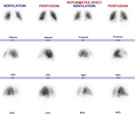 pulmonary embolism anatomy