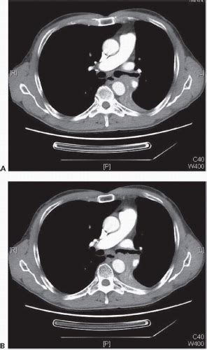 Pneumonectomy | Oncohema Key