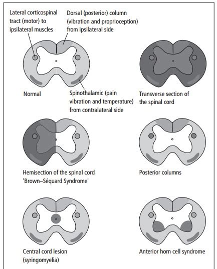 Tabes Dorsalis Spinal Cord