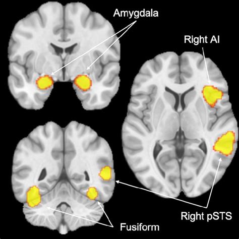 Regions Of Interest ROI Images For The Amygdala Right Anterior