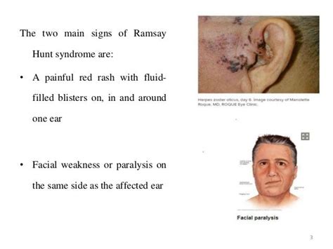 Ramsay Hunt Syndrome Ninaafekent