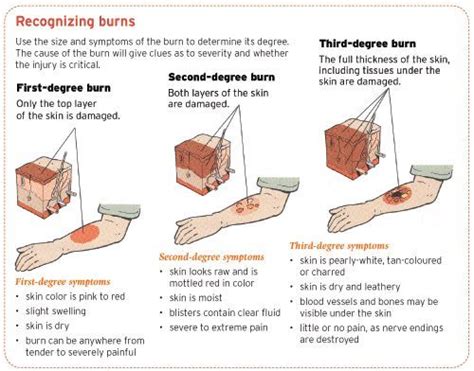 Recognizing Burns. Use the size and symptoms of the burn to determine its degree. The cause of ...