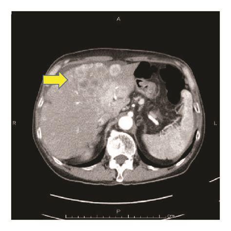 Dynamic Contrast Enhanced Computed Tomography Ct Scans Showed