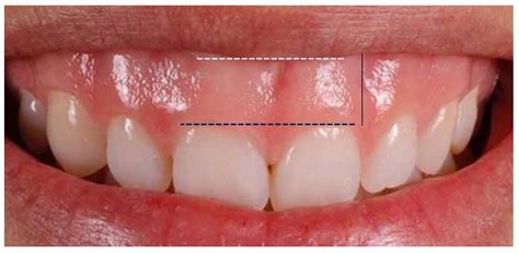 Healthcare Free Full Text Is There A Correlation Between Gingival