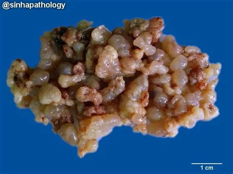 Botryoid Rhabdomyosarcoma Gross Pathology