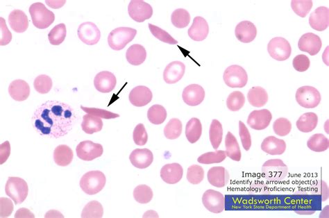 sickle cell anemia and drepanocytes on smear | Medical Laboratories