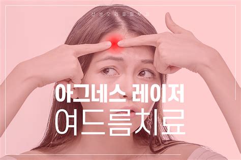 여드름원인이 되는 피지선 파괴 아그네스레이저 산본오라클피부과