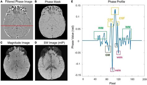 Frontiers Susceptibility Weighted Imaging At High Performance 0 5T