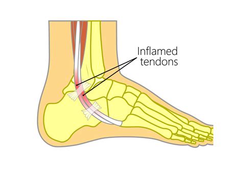 Peroneal Tendonitis - Upswing Health | Upswing Health