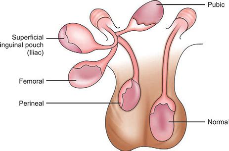 Testicle Guillotine