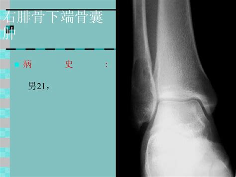 骨肿瘤x线病例图谱bword文档在线阅读与下载无忧文档