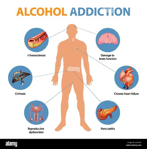 Addisons disease symptoms infographic illustration Stock Vector Image