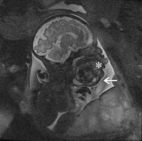 Congenital Oral Masses An Anatomic Approach To Diagnosis Radiographics