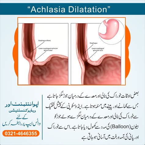 Achlasia Dilatation Drmasifgul