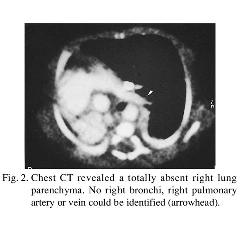 Anteroposterior Supine Chest Radiograph On Admission Showed Complete Download Scientific