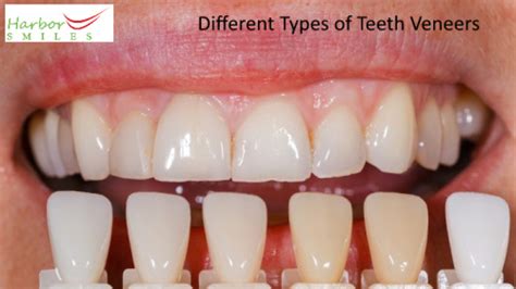 What Are The Different Types Of Veneers Harbor Smiles