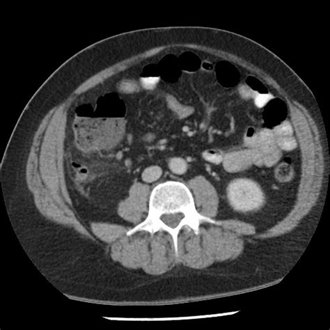 Appendicitis Ct Radiopaedia It Is A Very Common Condition In General Radiology Practice And Is