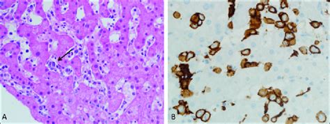 A Liver Sinusoids Also Demonstrate Scattered Large Atypical Appearing