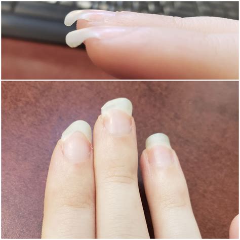 Why Are My Nails Growing Weird And Why Is My Nail Bed Disformed Rnails