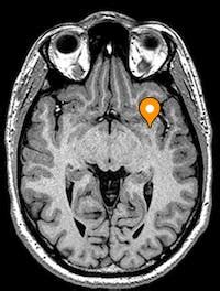 Uncinate fasciculus of cerebrum - e-Anatomy - IMAIOS