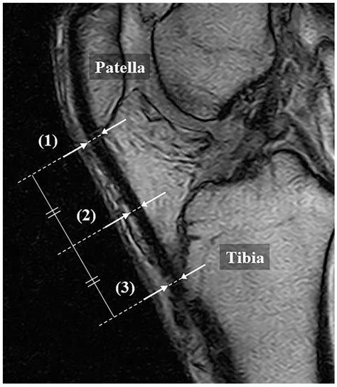 An Objective Measure Of Patellar Tendon Thickness Based On