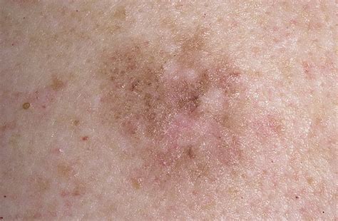 Early Stage Melanoma Skin Cancer Signs