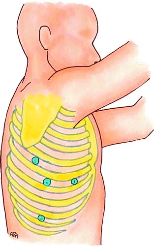 Mckeown Procedure Drawings Illustrate Transthoracic Esophagectomy