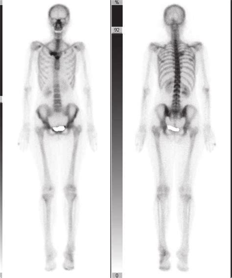 A Three Phase Bone Tc 99m Scan Showing A Non Infectious Uptake In The