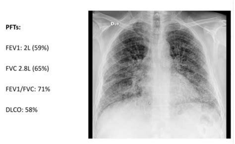 Idiopathic Pulmonary Fibrosis Flashcards Quizlet